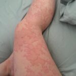 Identificando y Tratando Erupciones Cutáneas de Forma Natural