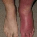 ¿Por qué tus pies pueden hincharse y cómo aliviar esta condición con remedios naturales?