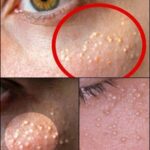 Cómo Eliminar las Bolitas Blancas de la Piel: Remedios Naturales para las Milia