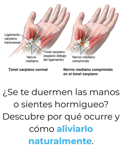 Síndrome del túnel carpiano