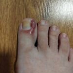 Cómo Tratar un Uñero en Casa: Remedios Naturales Efectivos
