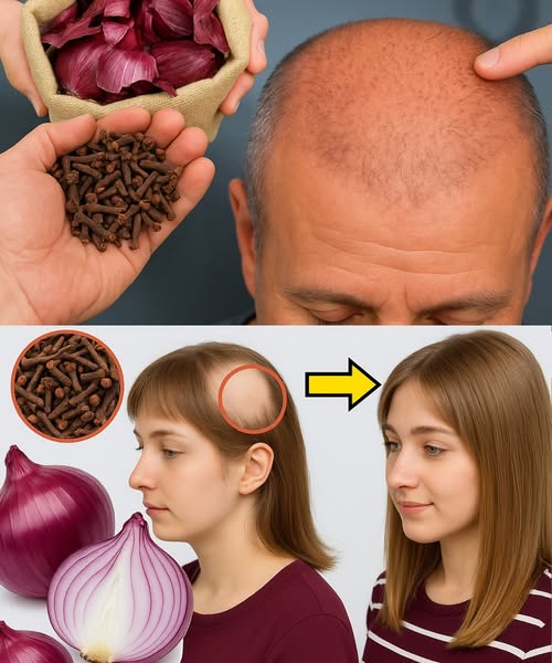 Remedio casero para el crecimiento del cabello con cebolla y clavos de olor