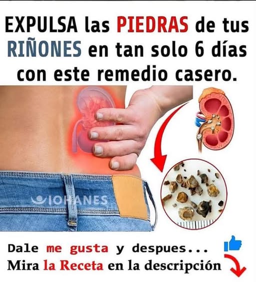 Piedras Renales