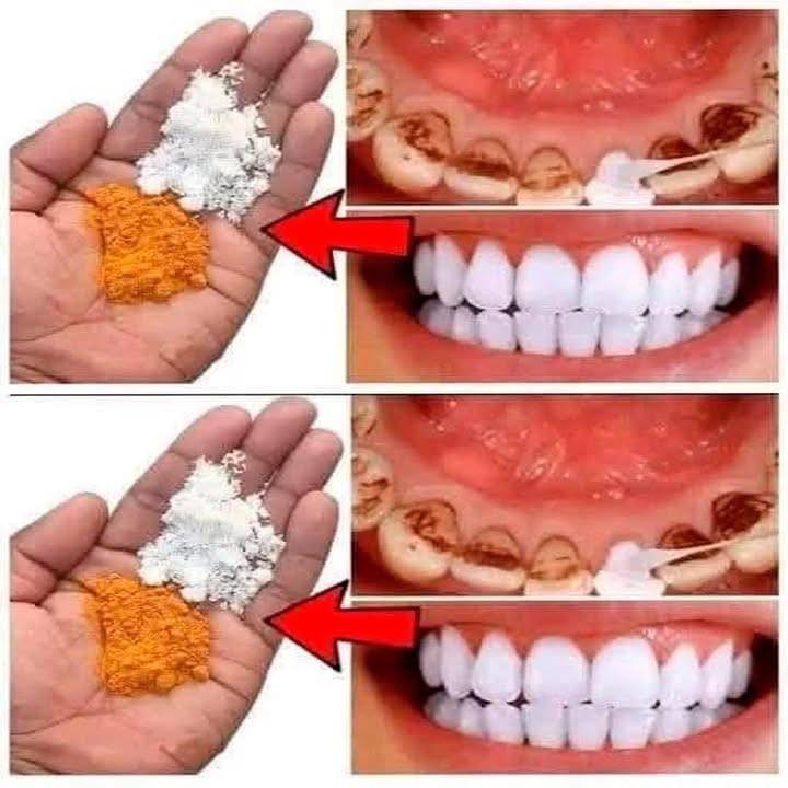 Remedio casero para blanquear dientes