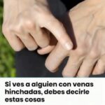 Venas Hinchadas: Significado y Remedios Naturales para Mejorar Tu Salud