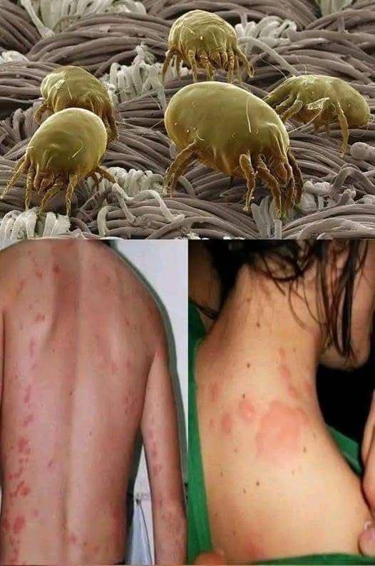 Ácaros del polvo y reacciones en la piel