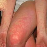 Remedios Naturales para Sarpullidos y Erupciones Cutáneas