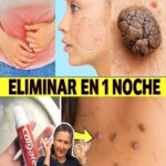 Elimina Verrugas y Lunares Con Yodo: Truco Casero para Usar Mientras Duermes