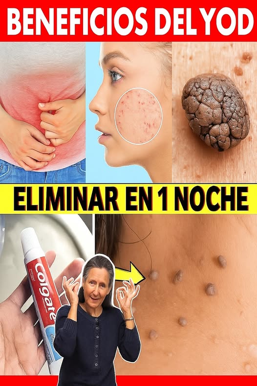 Elimina verrugas y lunares