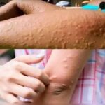 Picazón en la Piel: Causas, Diagnósticos y Remedios Naturales