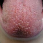 Bolitas en la Lengua: Causas, Tratamientos y Remedios Naturales