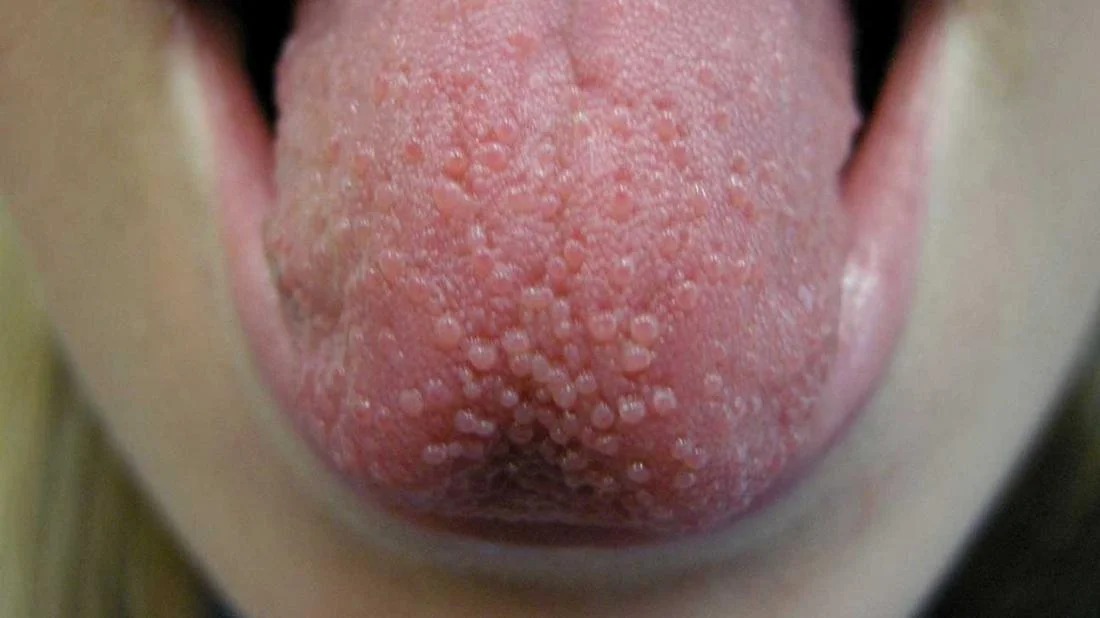 Bolitas en la lengua
