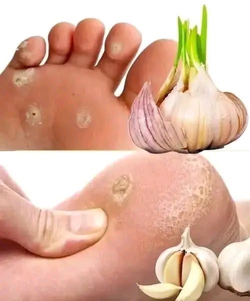 Uso de ajo como remedio natural para verrugas en los pies