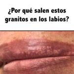 Granitos Blancos en los Labios y Zona Íntima: Causas y Remedios Naturales