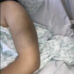 Consecuencias y Remedios Naturales para Moretones
