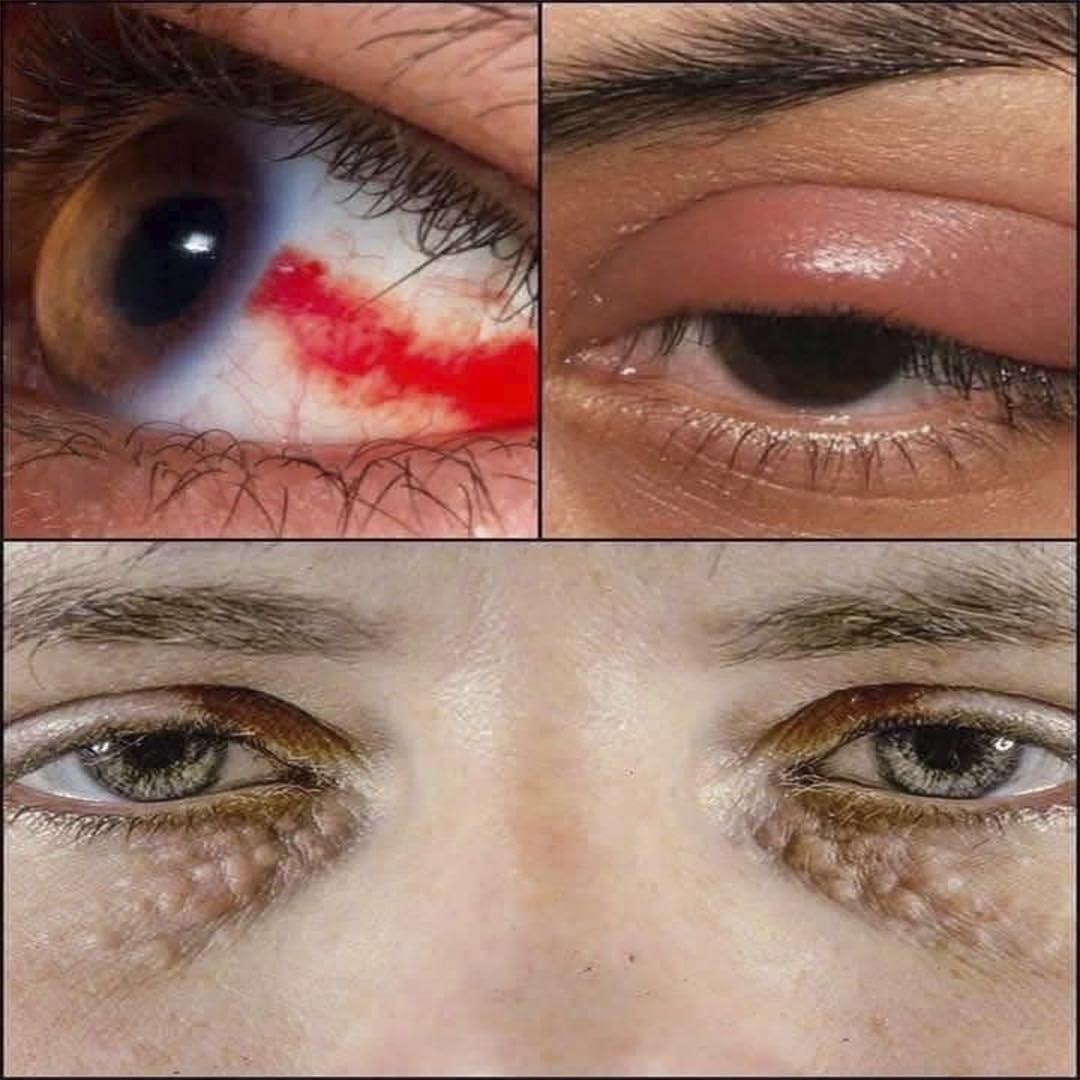 Señales en los ojos