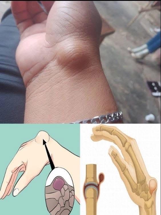 Diagrama de un ganglión en la muñeca