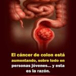 Cáncer de Colon en Jóvenes: Prevención y Remedios Naturales