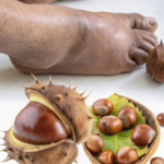 El Poder de las Castañas: Remedio Natural para Piernas Hinchadas