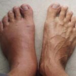 Consecuencias de Dormir con un Pie Hinchado y Cómo Aliviar la Inflamación