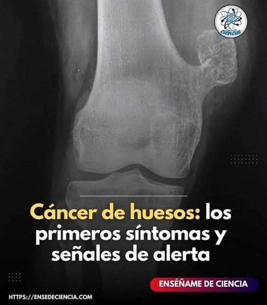 Radiografía de un hueso con cáncer