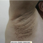 Descubre los Primeros Síntomas de Acrocordones y su Prevención con Remedios Naturales
