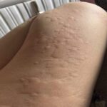 Signos en la Piel: Reacciones y Remedios Naturales