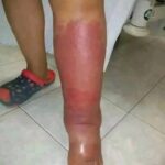Los Primeros Síntomas de Inflamación: Cómo Reconocer y Tratar de Manera Natural