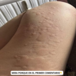 Descubre Signos de Deshidratación en la Piel y Remedios Caseros