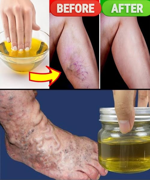 Remedios Caseros para las Venas Varicosas