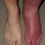 Hinchazón en los Pies: Causas, Tratamientos Caseros y Consejos de Salud