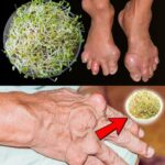 Elimina los Cálculos Renales y la Gota de Forma Natural: Remedios Caseros con Plantas