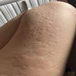 Signos en la Piel: Reconociendo la Urticaria y Remedios Naturales