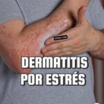 Dermatitis por Estrés: Cómo el Estrés se Manifiesta en Nuestra Piel