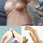 Quistes de Ganglio en la Muñeca: Causas, Síntomas y Remedios Naturales
