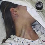 Distensión Yugular Masiva: Un Signo de Alarma que No Debes Ignorar
