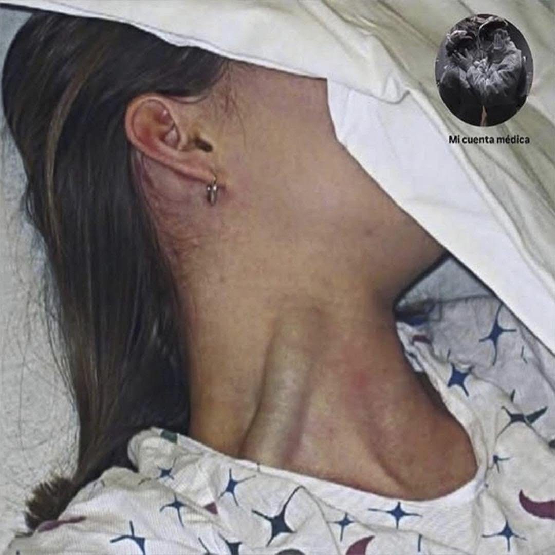 Paciente en hospital con distensión yugular masiva