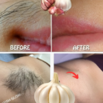 Eliminar el Vello Facial y Corporal de Forma Natural con Ajo