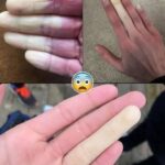 Cómo Manejar el Fenómeno de Raynaud: Consejos y Remedios Caseros