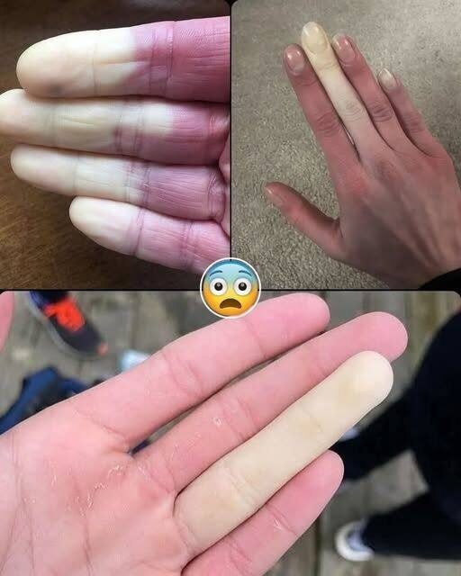 Ejemplo de manos con fenómeno de Raynaud