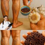 Elimina las Várices de Forma Natural con Ajo y Clavos de Olor
