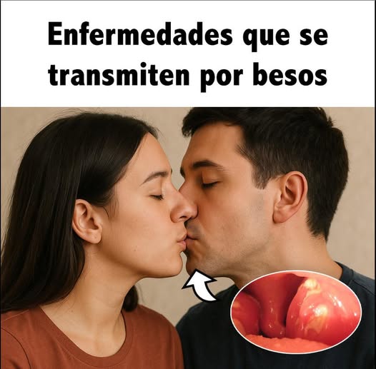 Enfermedades transmitidas por besos
