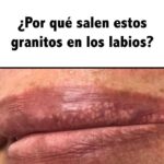 Granitos en los Labios: Causas y Remedios Naturales