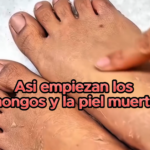 Hongos en los Pies: Causas y Remedios Naturales para Combatirlos