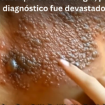 Remedios Caseros para la Culebrilla: Alivio Natural para el Herpes Zoster