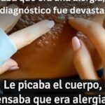 Remedios Caseros para la Culebrilla: Alivio Efectivo y Natural
