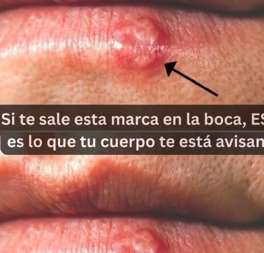 Remedios naturales para aftas y herpes