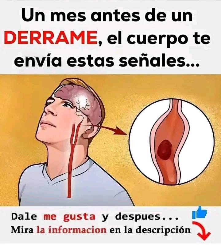 Señales de advertencia de un derrame cerebral