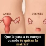 Histerectomía y sus Efectos en el Cuerpo Femenino