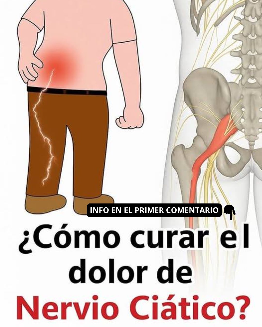 Dolor del nervio ciático